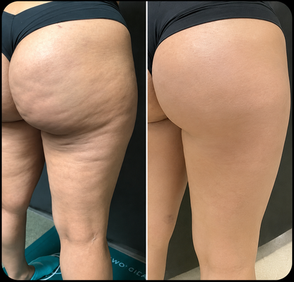 Allevia Lift — Appareil jambes légères & drainage